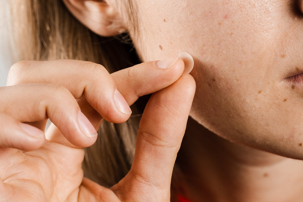 How Long to Leave a Pimple Patch On for Best Results | Rael